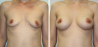 Фото до и после подтяжки груди у доктора Дениса Баги