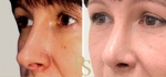 Фото до и после пластики носа у доктора Светланы Пшонкиной