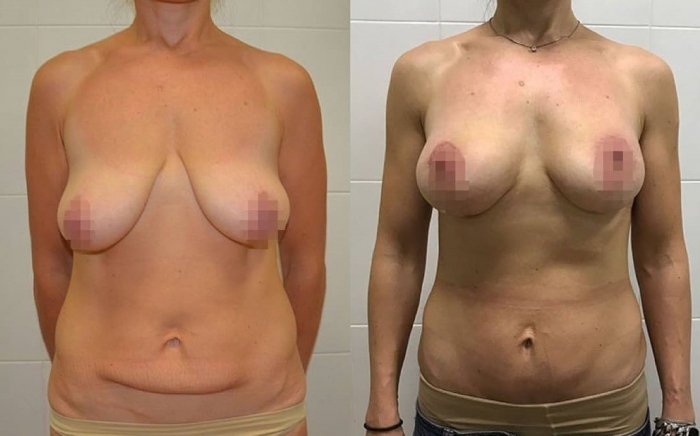 До и после миниабдоминопластики и пластики груди у доктора Ольги Ованесовой