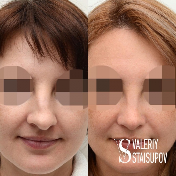 Пациентка доктора Валерия Стайсупова до и после ринопластики