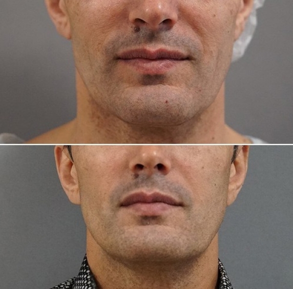 Пациент доктора Пенаева до и после мультитехнологичного лифтинга лица