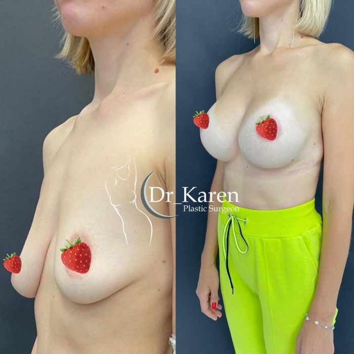 Пациентка доктора Карена Пайтяна до и после подтяжки груди с увеличением