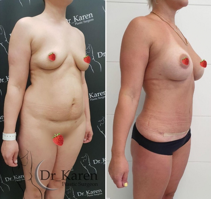 Пациентка доктора Карена Пайтяна до и после подтяжки живота, липосакции и маммопластики